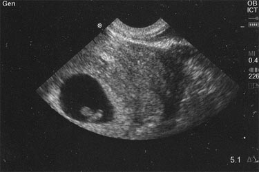 4 week vaginal ultrasound pictures